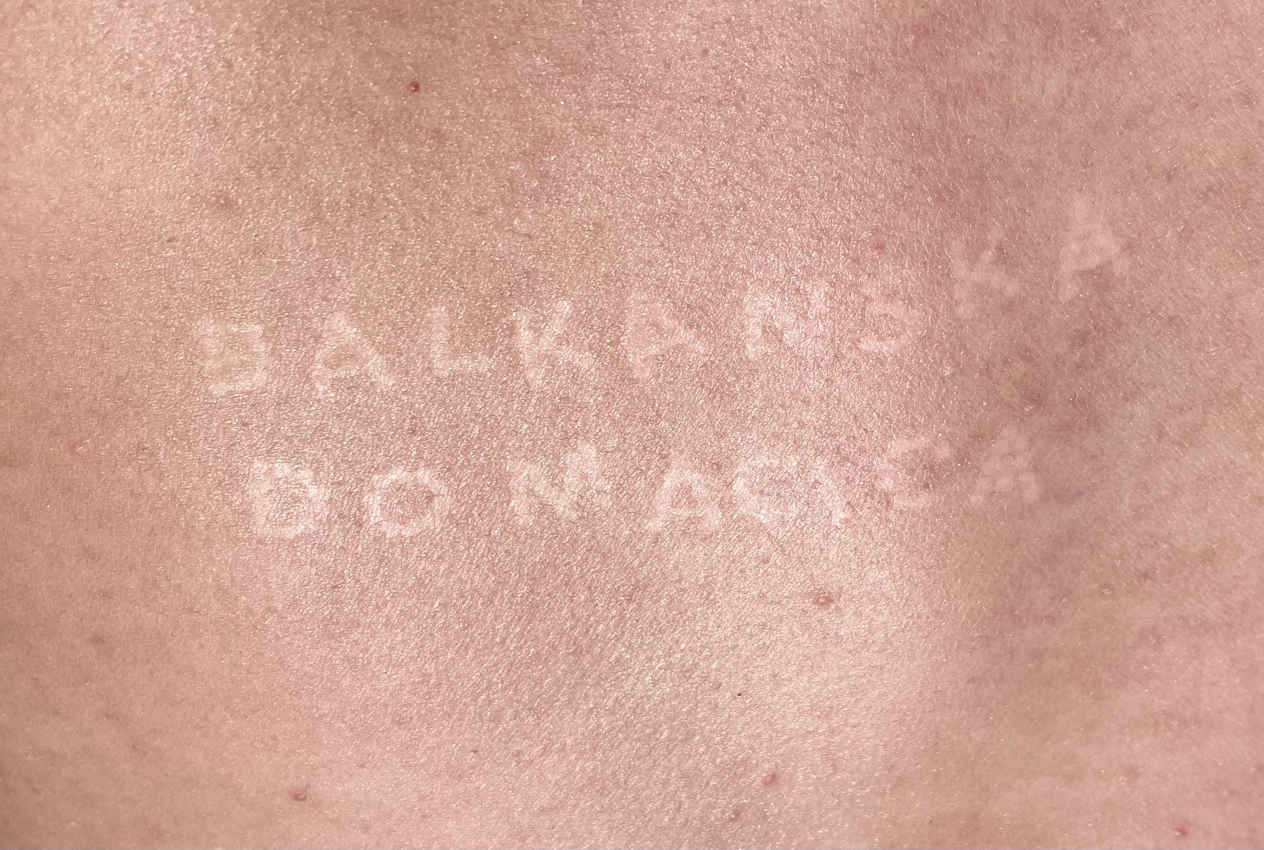 In the work "Balkan Whore," I inscribed on my skin the titles of Telegram groups where men from the Balkans share unsolicited photos of their female relatives, including children, girls, mothers, nieces, and grandmothers. This patriarchal label is imprinted on my skin through sunburns, highlighting the objectification and dehumanization of women.